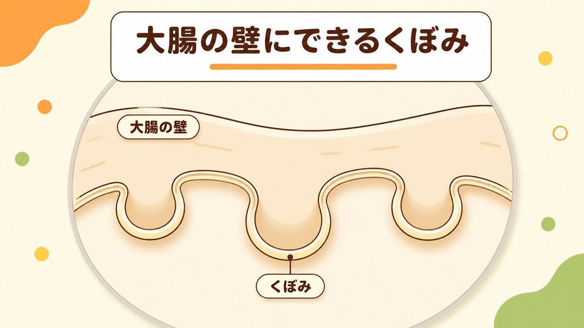 大腸憩室とは大腸の壁にできるくぼみ