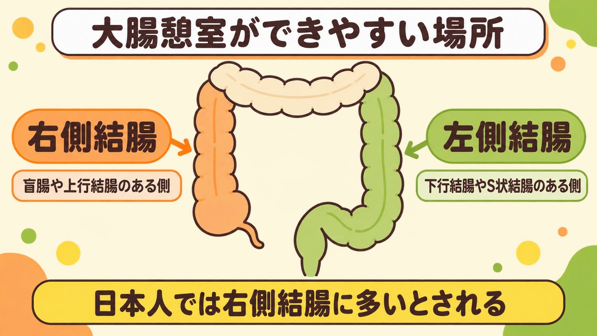 大腸憩室ができやすい場所(右側結腸と左側結腸)を示した図