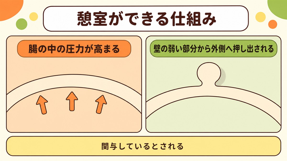 腸の中の圧力が高まって大腸憩室ができる仕組みの図