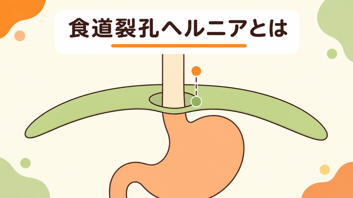 食道裂孔ヘルニアとは胃が横隔膜より上にせり上がった状態