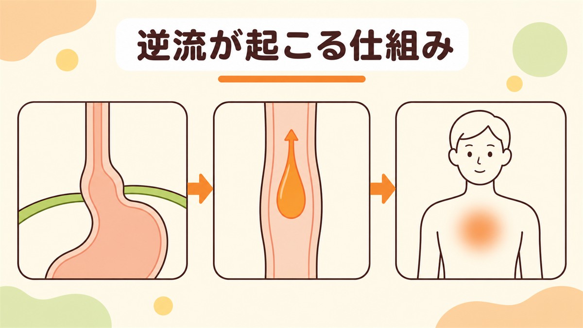 食道裂孔ヘルニアが胃酸の逆流から症状につながる仕組み