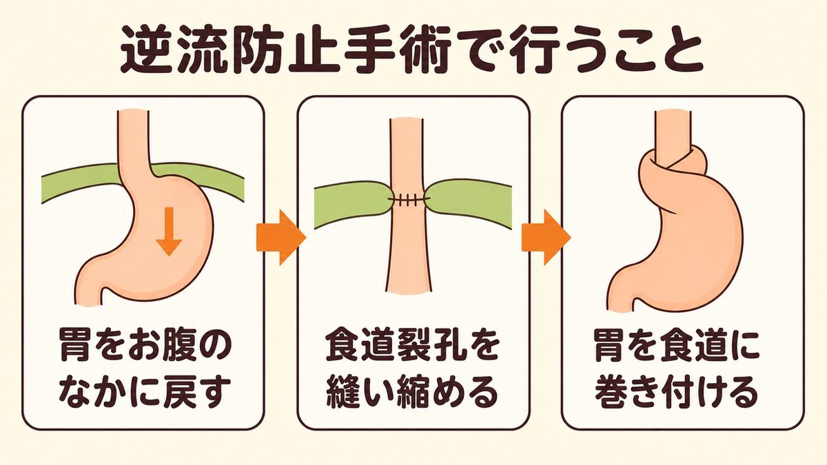 逆流防止手術で行うことの3段階