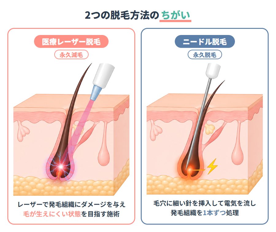 医療レーザー脱毛とニードル脱毛のちがい