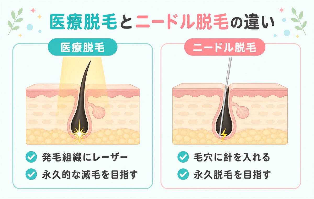 医療脱毛とニードル脱毛の違い