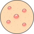 毛嚢炎（もうのうえん）