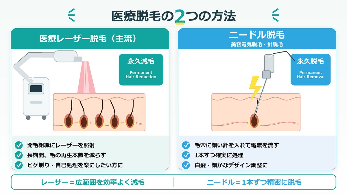 医療脱毛の2つの方法｜医療レーザー脱毛（永久減毛）とニードル脱毛（永久脱毛）の比較図