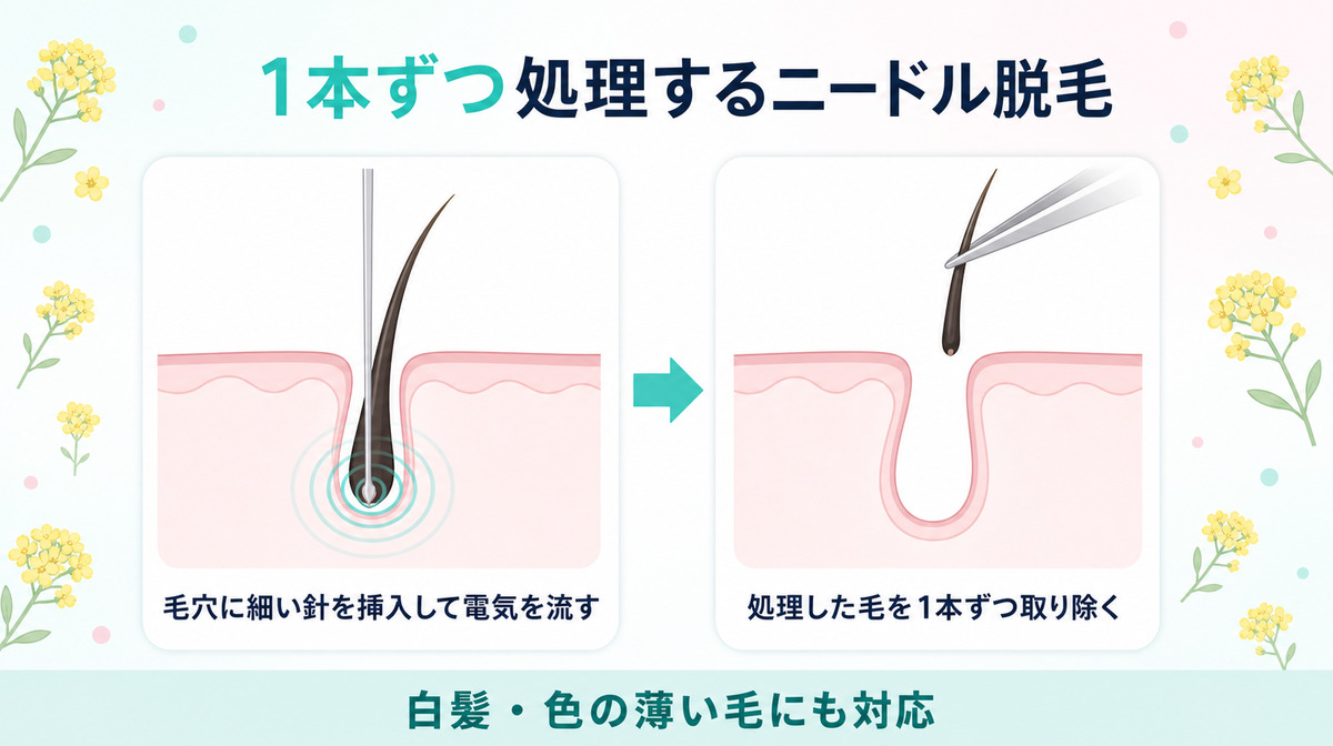 1本ずつ処理するニードル脱毛の仕組み