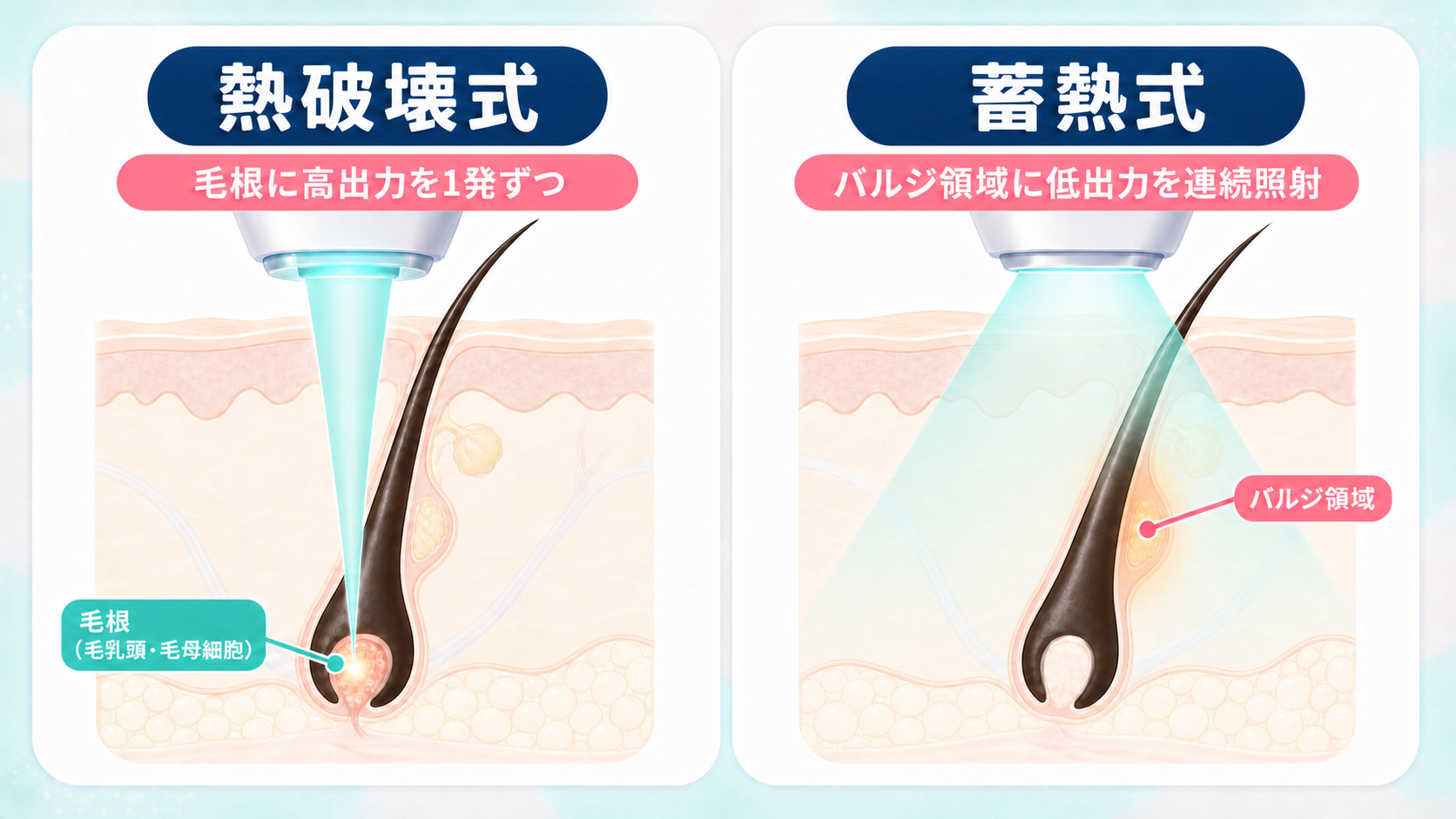 熱破壊式と蓄熱式の照射方法の違いを毛根とバルジ領域で比べた図解