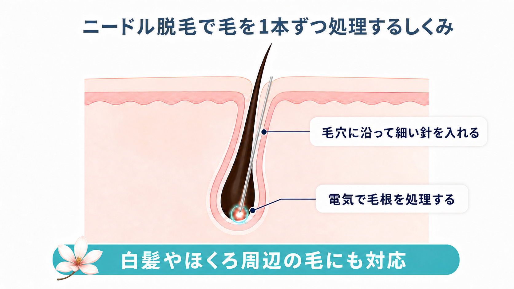 1本ずつ処理するニードル脱毛の仕組み