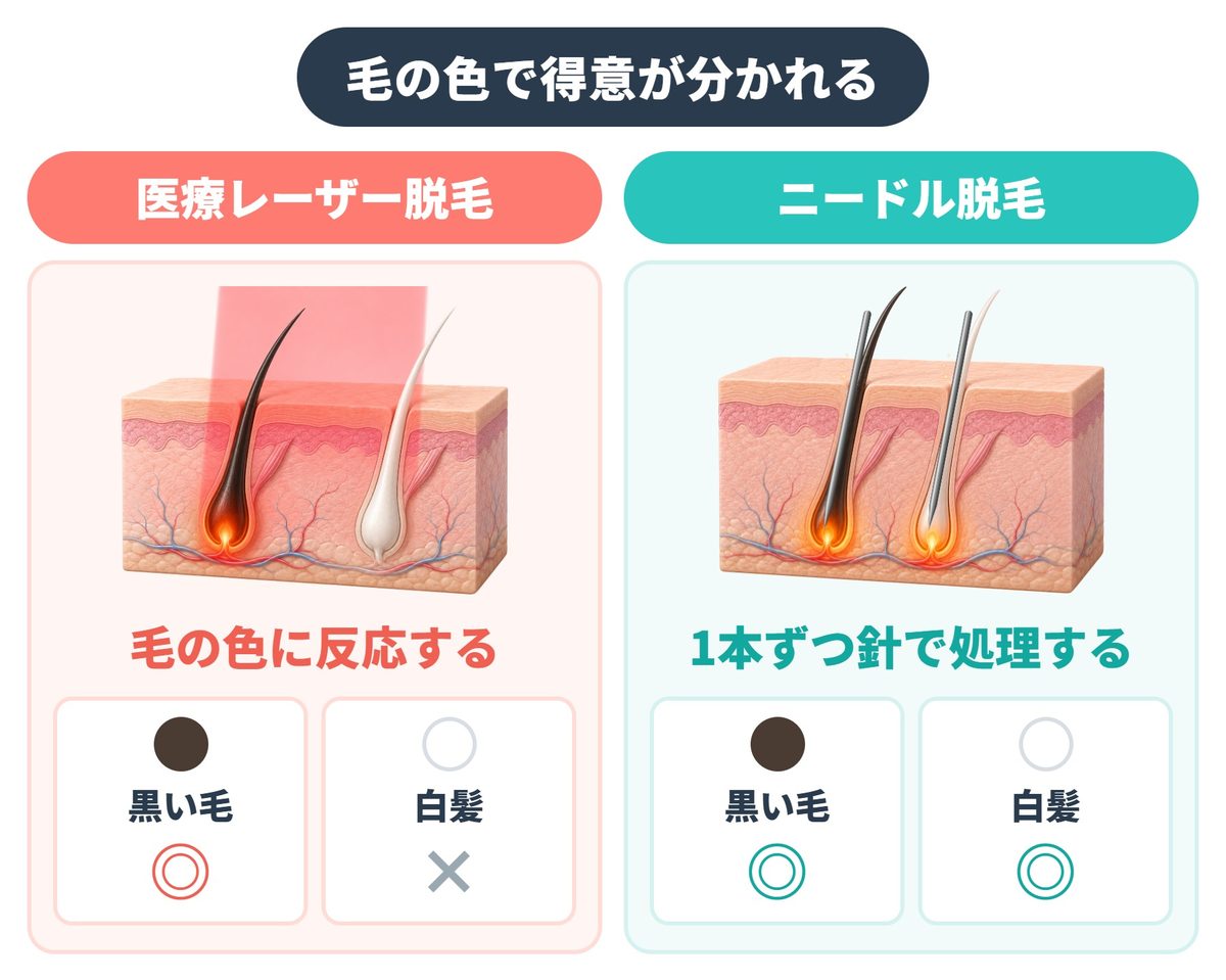 永久脱毛を目指すなら?札幌のニードル脱毛(針脱毛)を扱う医療機関と料金