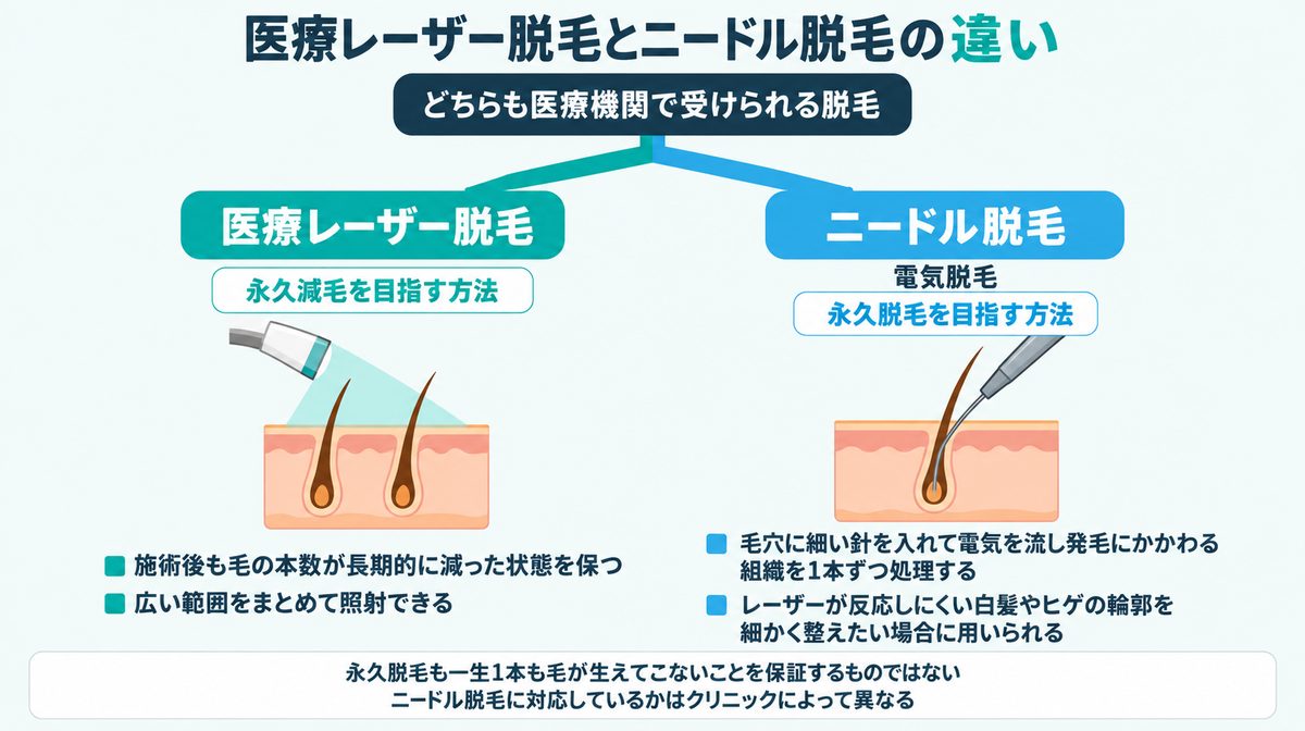 医療脱毛の2つの方法|医療レーザー脱毛(永久減毛)とニードル脱毛(永久脱毛)の比較図