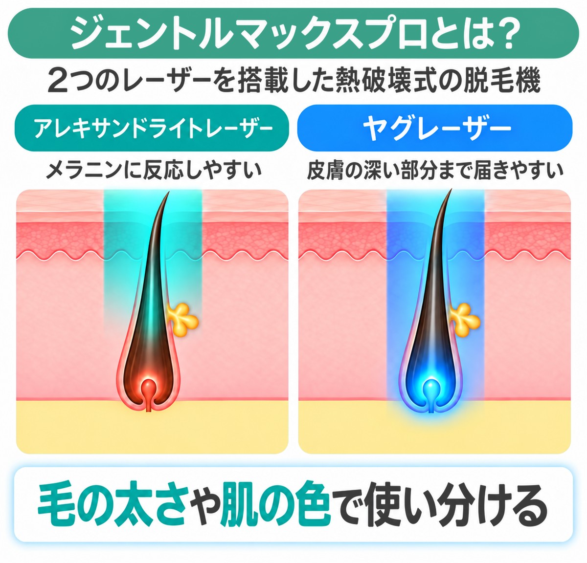 ジェントルマックスプロとは|アレキサンドライトレーザーとヤグレーザーを搭載した熱破壊式の脱毛機