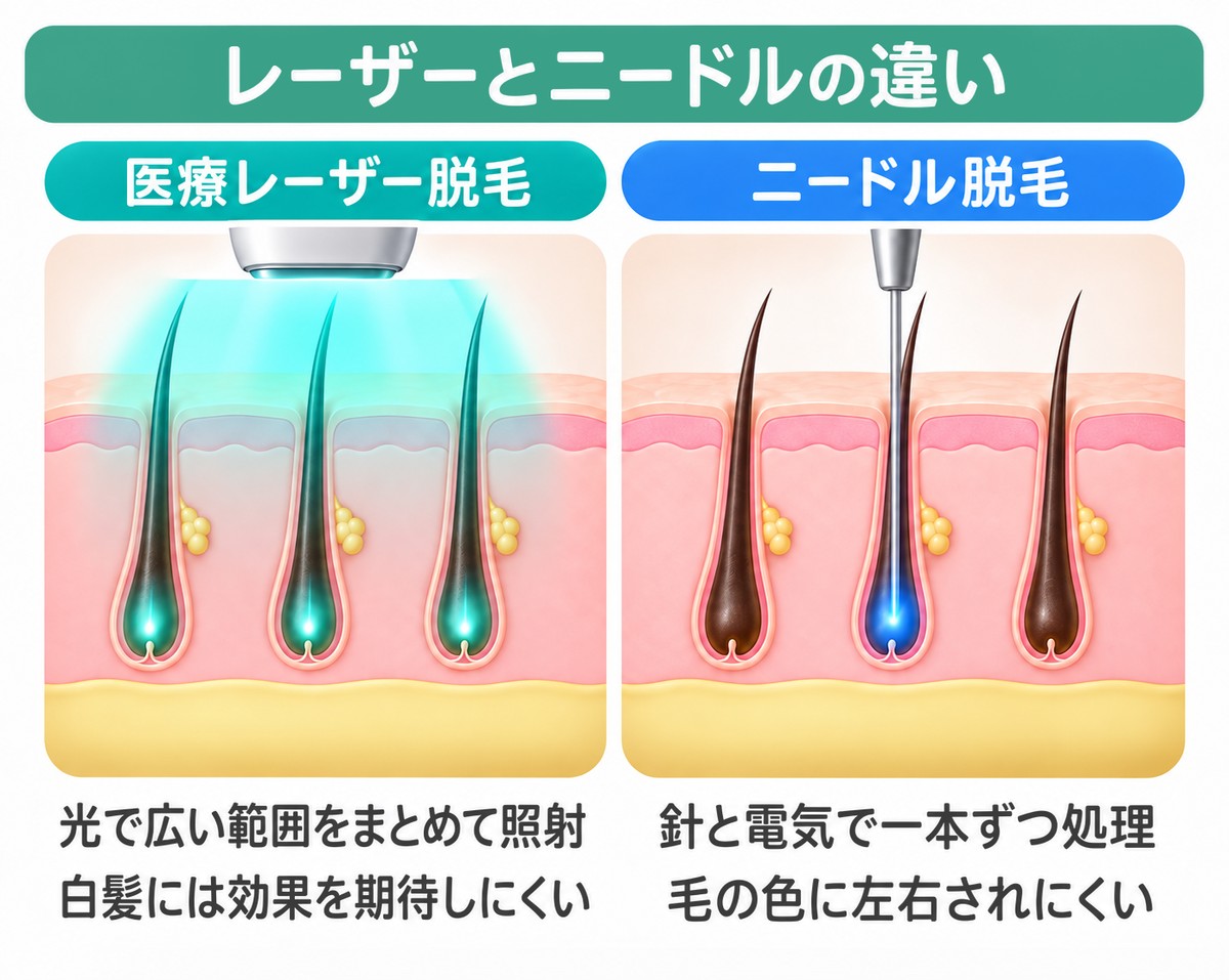 レーザーとニードルの違い|光で広い範囲をまとめて照射する医療レーザー脱毛と針と電気で一本ずつ処理するニードル脱毛