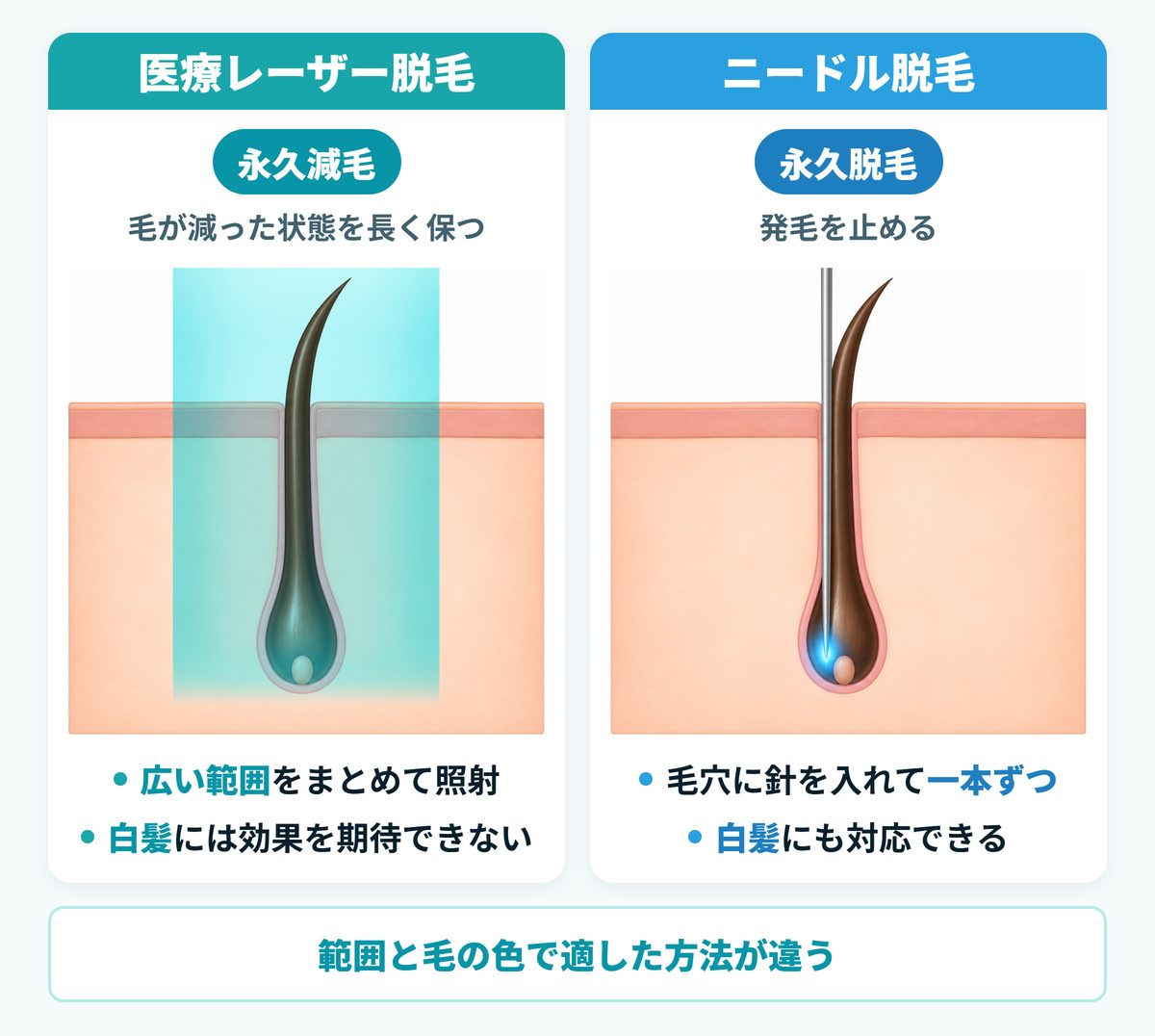 医療レーザー脱毛とニードル脱毛の違い｜永久減毛と永久脱毛の仕組みと白髪への対応の比較図