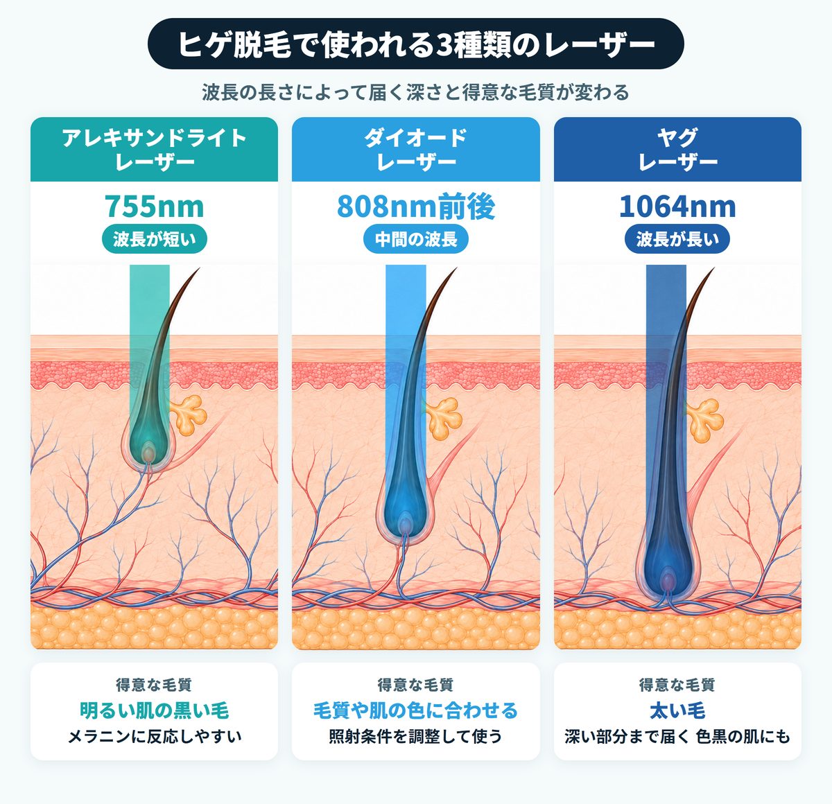 ヒゲ脱毛に使う3種類のレーザーの違い｜アレキサンドライト・ダイオード・ヤグの波長と届く深さの比較図