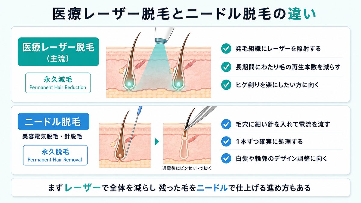 医療脱毛の2つの方法｜医療レーザー脱毛（永久減毛）とニードル脱毛（永久脱毛）の比較図
