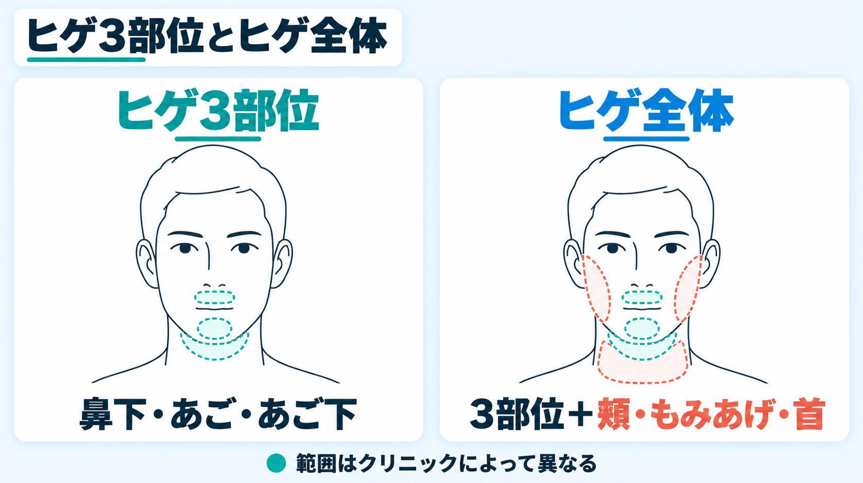 ヒゲ3部位とヒゲ全体の範囲の違い