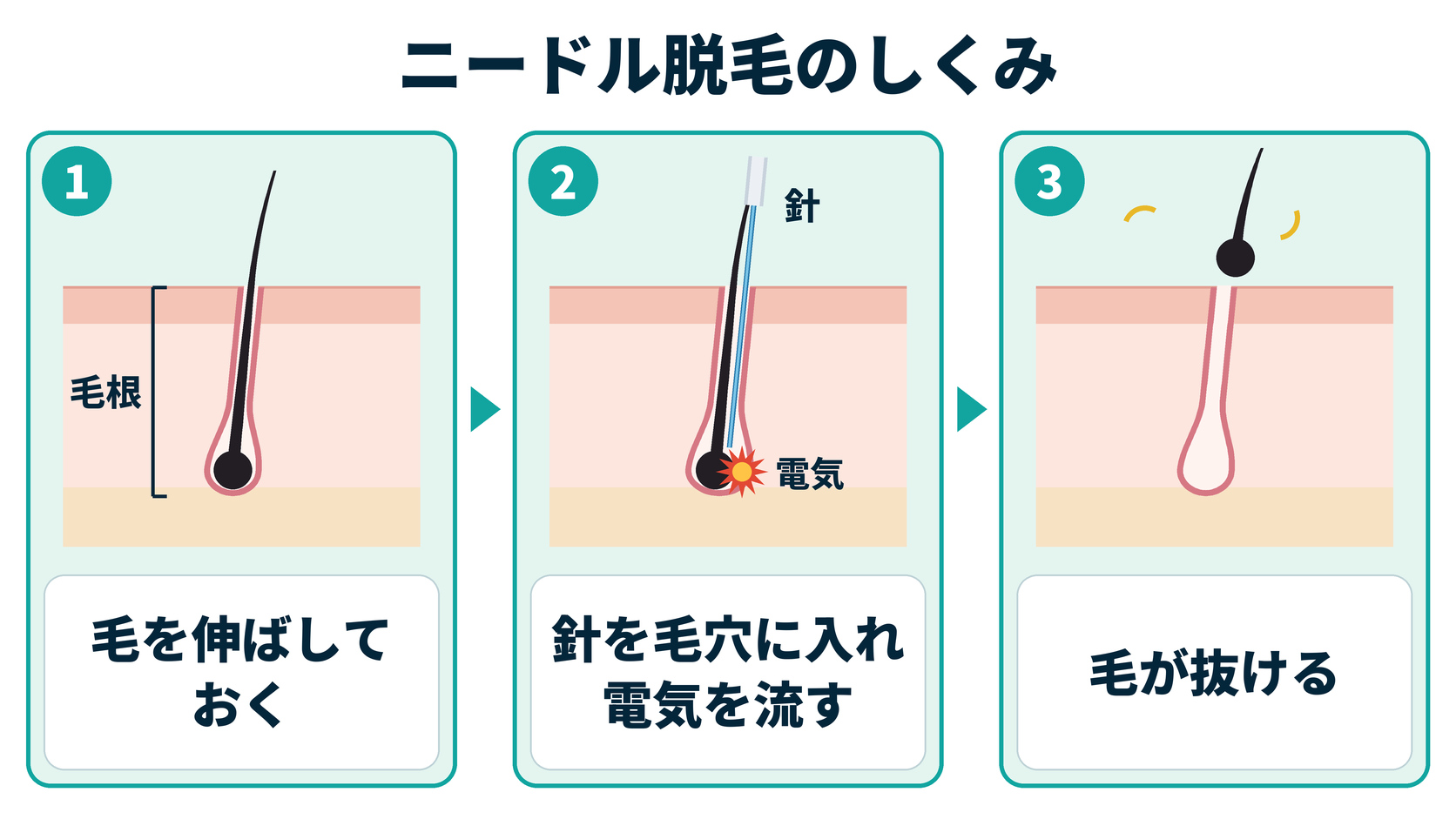 ニードル脱毛のしくみ(毛を伸ばしておく、針を毛穴に入れ電気を流す、毛が抜ける)