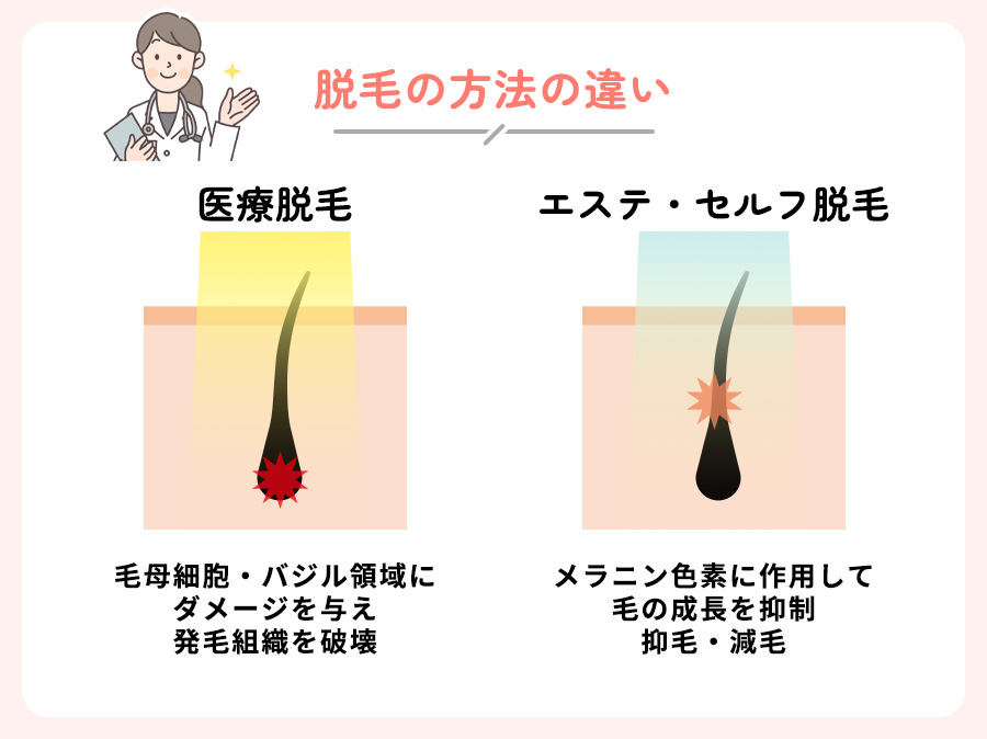 医療脱毛・エステ・セルフ脱毛の脱毛イメージの図説