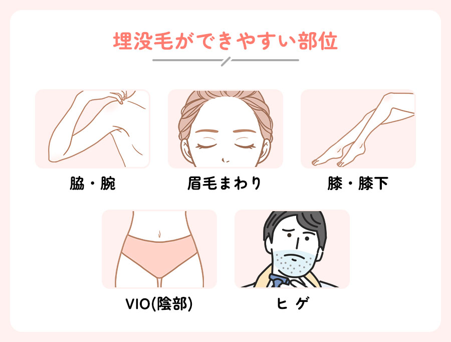 埋没毛ができやすい部位の図説