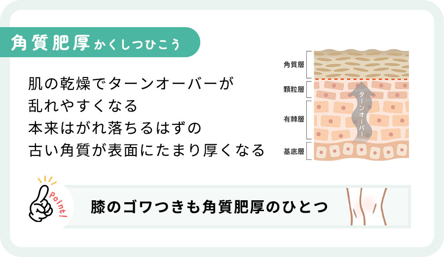 角質肥厚の解説
