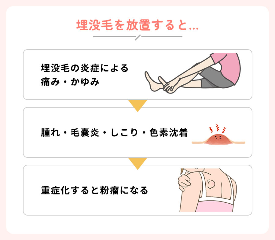 埋没毛を放置していくと起こるリスク一覧