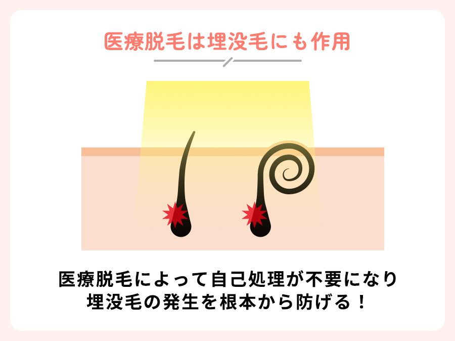 医療脱毛は埋没毛の発生の根本を防ぐ！